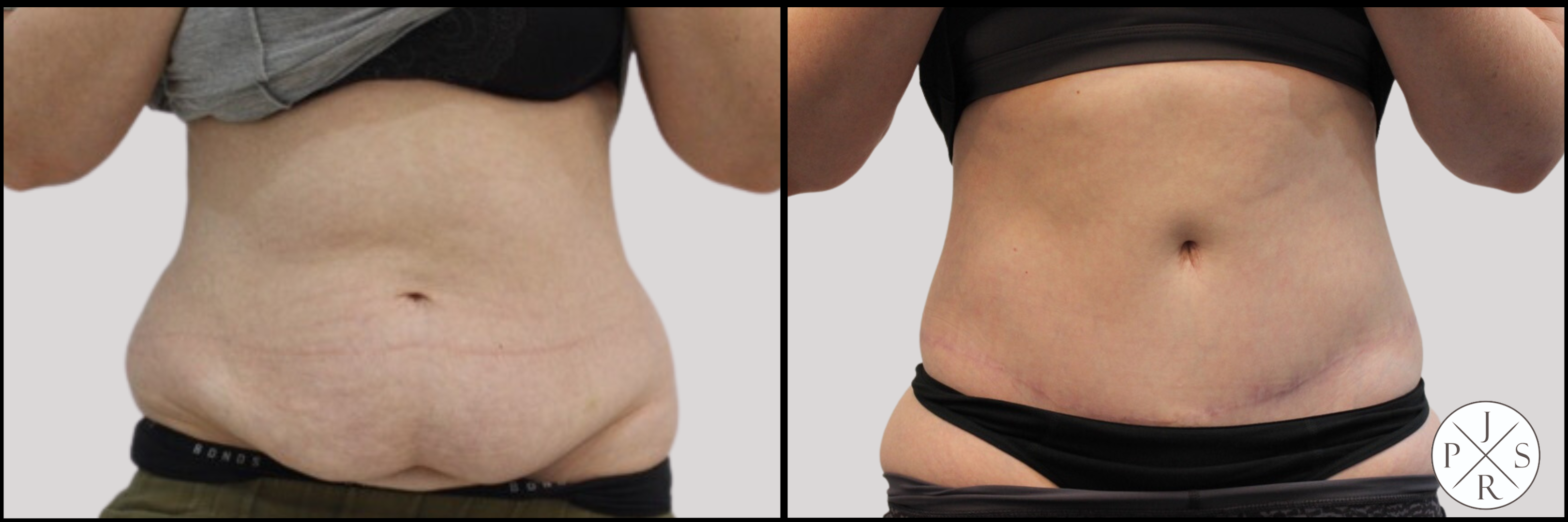 Abdominoplasty Before & After Image